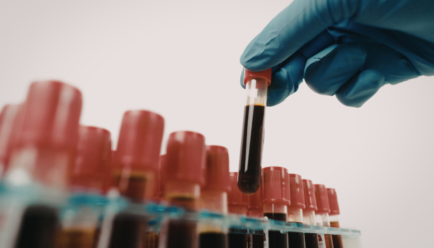 Blood Analysis in London: How to Choose the Right Laboratory ?